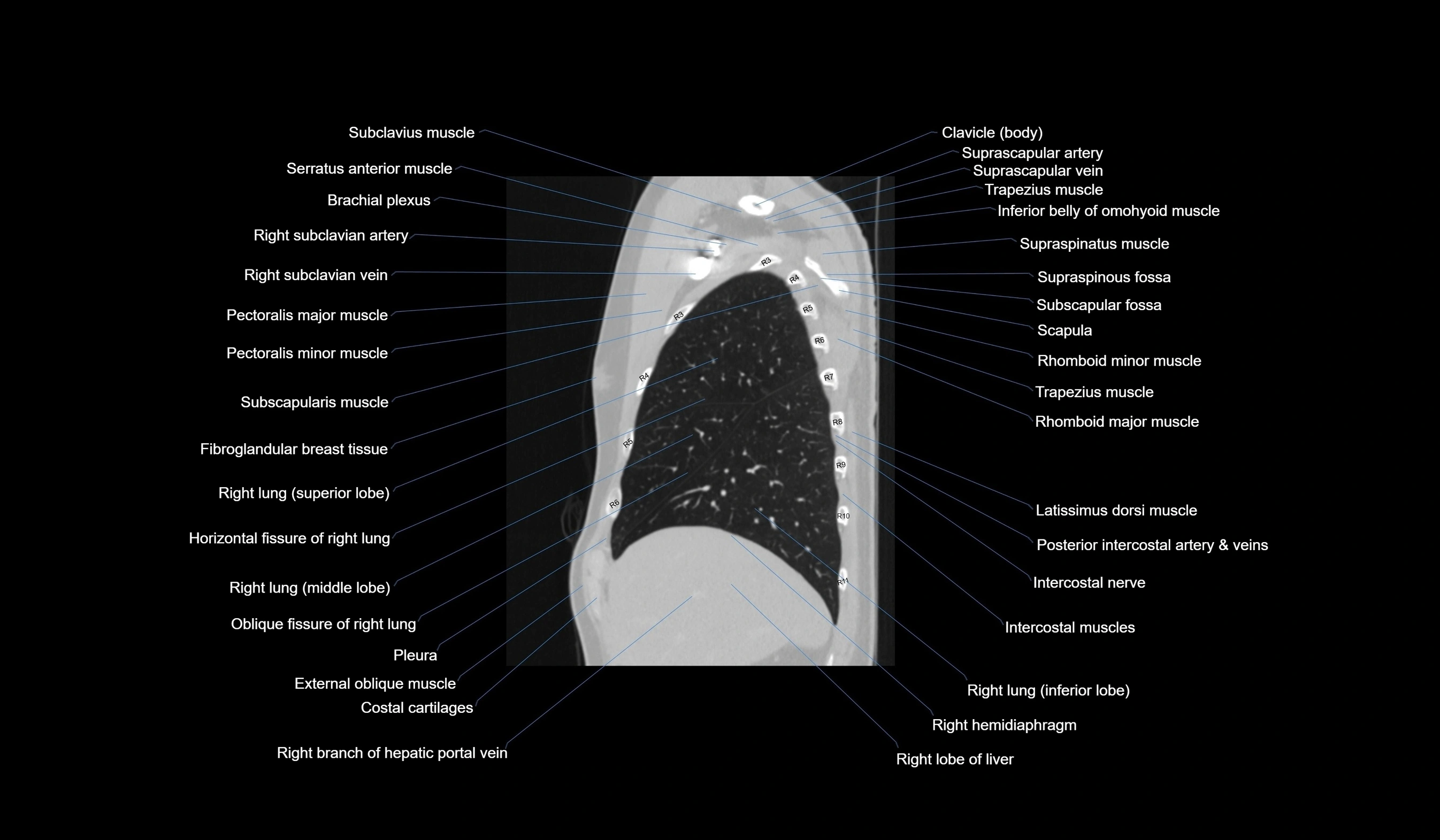 CT chest (thorax) labelled sagittal cross sectional anatomy radiology image-00034.webp